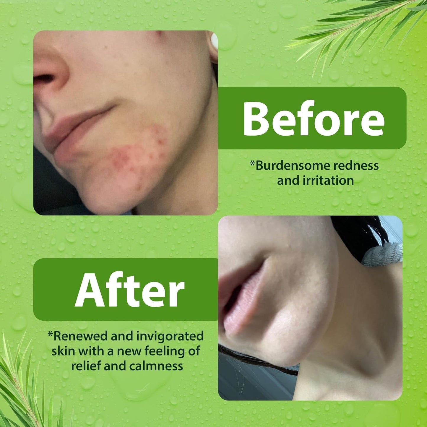 Derma-nu Antibacterial Body Wash - Tea Tree Soap for Jock Itch, Athlete’s Foot & Acne